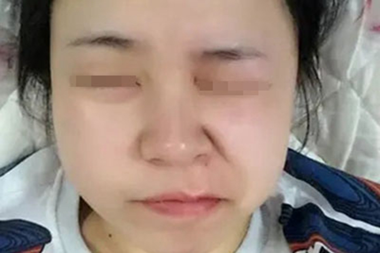 周围性面瘫面部变形图