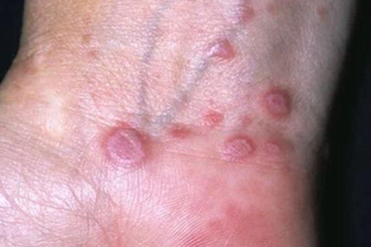 光化性扁平苔藓手腕症状图 光化性扁平苔藓手腕症状图