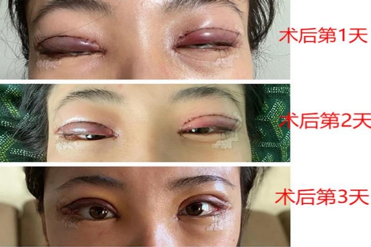 割双眼皮术后1-3天图
