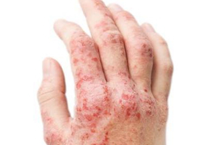 丘疹坏死性结核疹手背症状图
