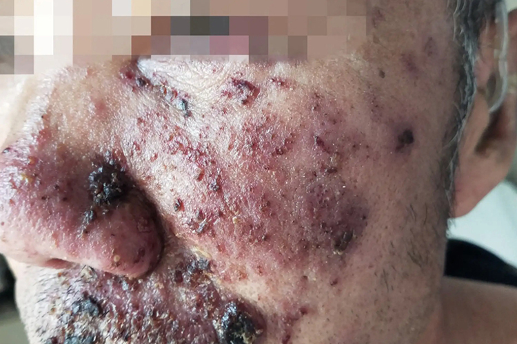 带状疱疹鼻子症状图