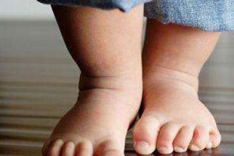 下肢肌张力高双腿不能分开图