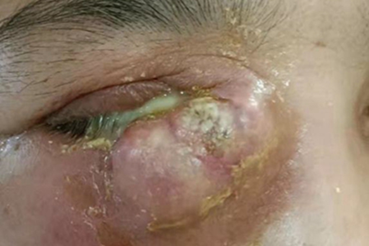 眶蜂窝织炎眼周症状图 眶蜂窝织炎眼周症状图