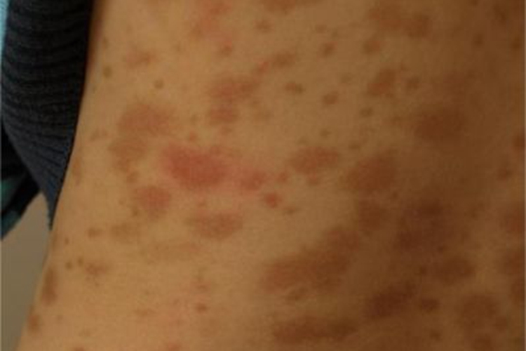 色素性荨麻疹背部红斑图 色素性荨麻疹背部红斑图
