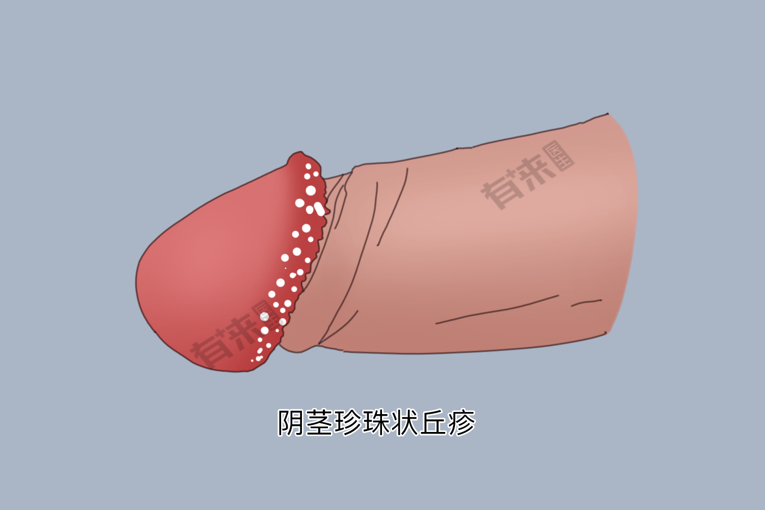 冠状沟有白色的小疙瘩是怎么回事