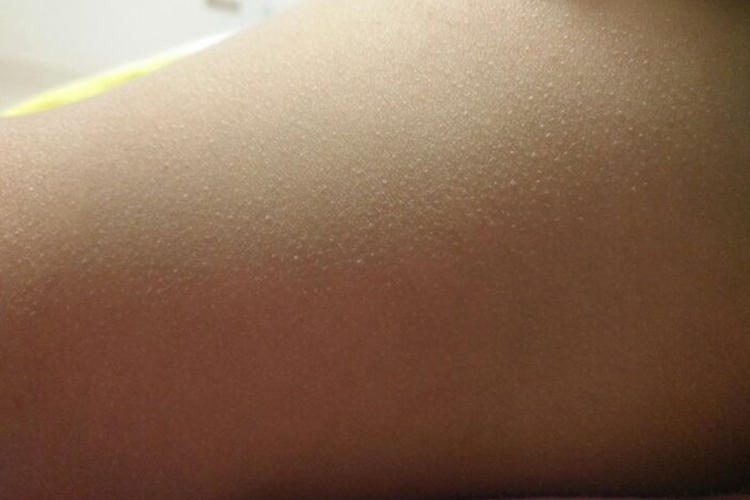 宝宝腿上毛周角化症图