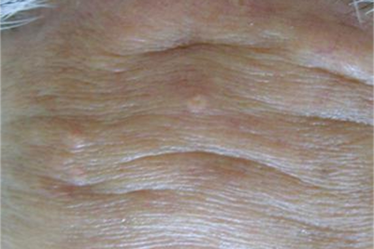 老年性皮脂腺增生前额丘疹图