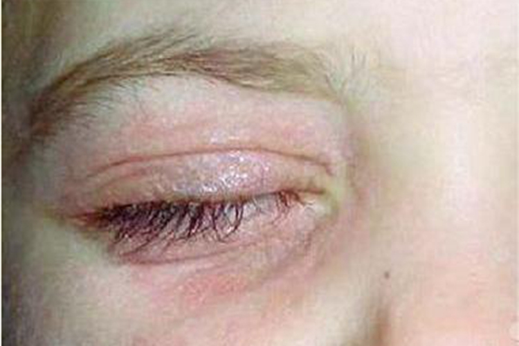 阴虱病眼睑肿图