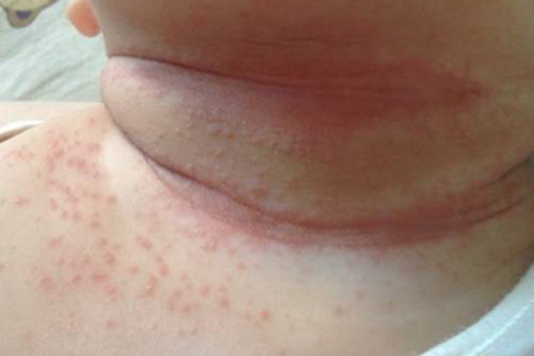 红痱颈部小红疙瘩图