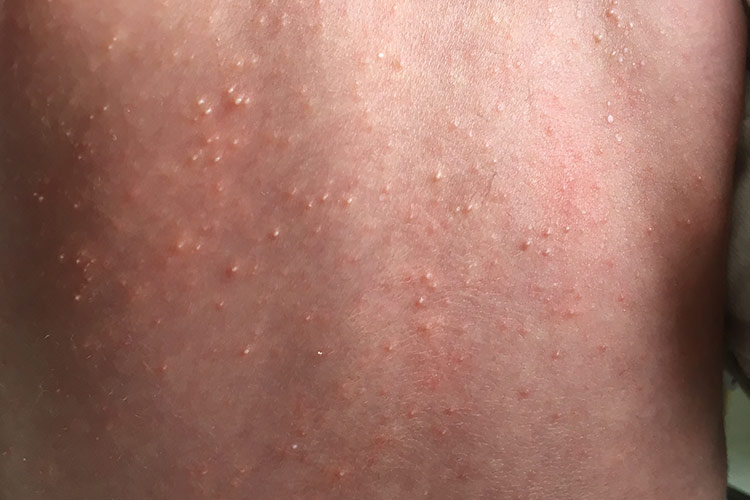 婴儿白痱图 婴儿白痱图