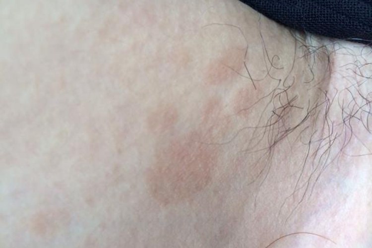 大腿根褐色花斑糠疹图