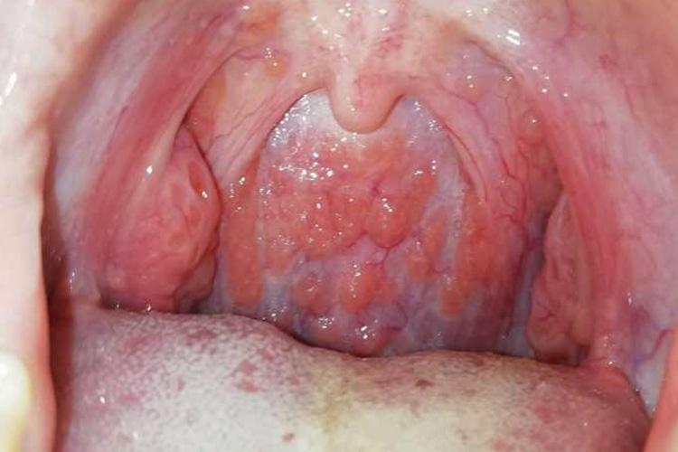 融合成块的淋巴滤泡图