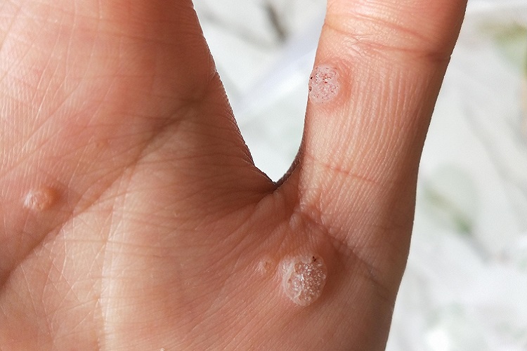 疣手部小疙瘩图