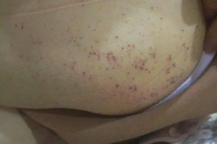 穿通性毛囊炎臀部丘疹图 穿通性毛囊炎臀部丘疹图