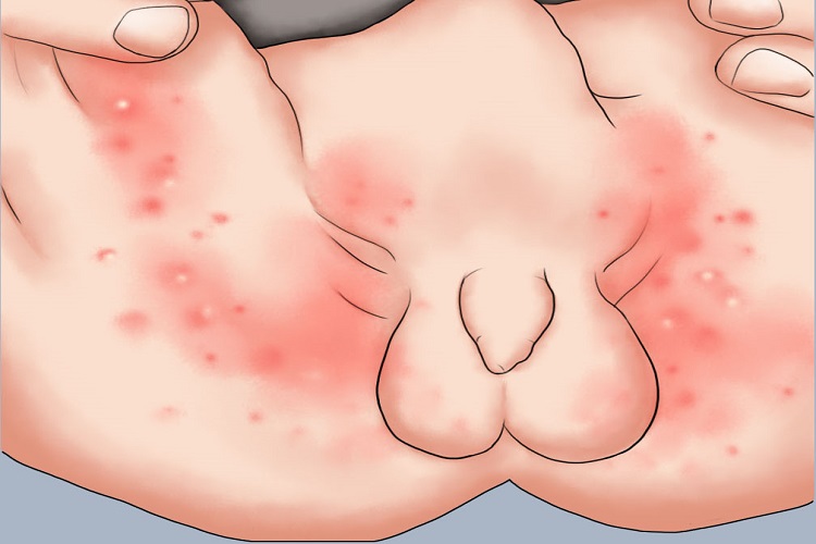 股癣会阴部红斑手绘图 股癣会阴部红斑手绘图