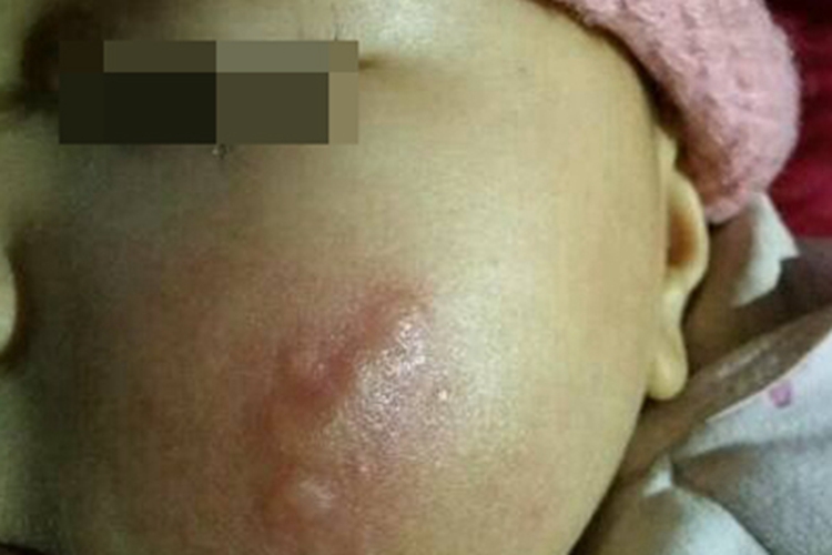 冻疮面部症状图