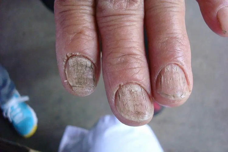 甲营养不良指甲增生图