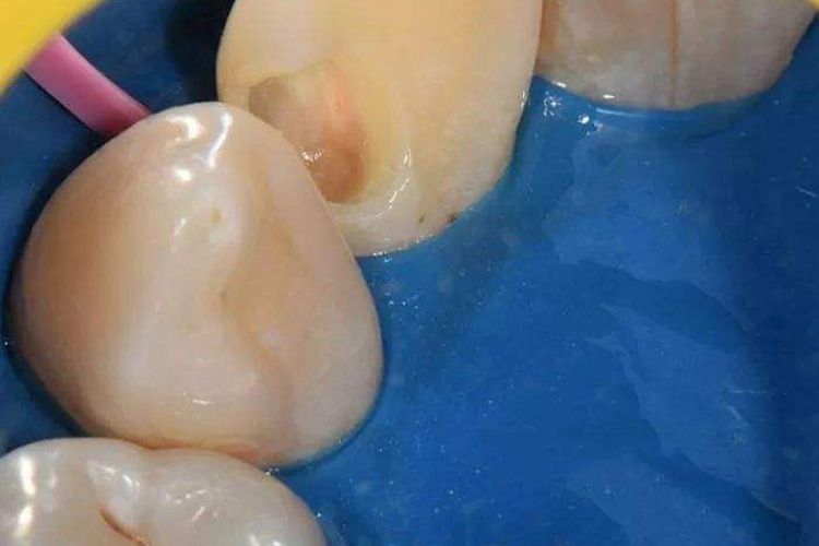 门牙邻面龋早期症状图