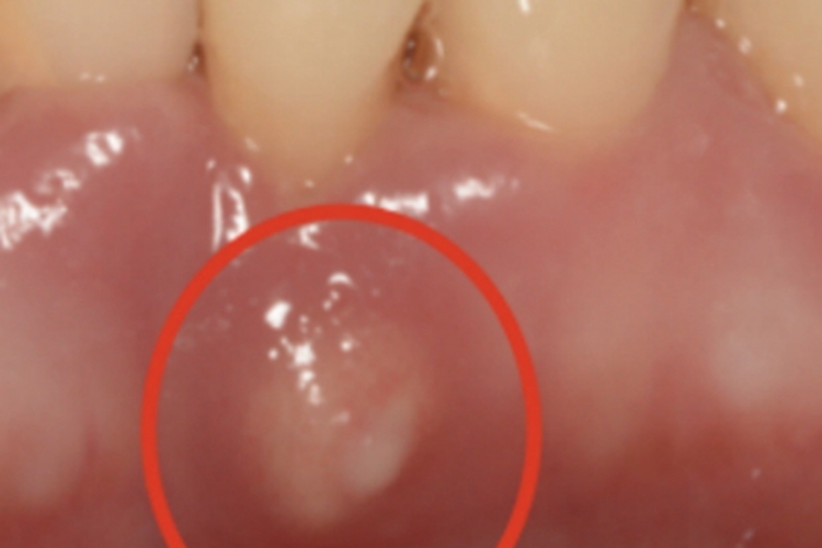 侵袭性牙周炎硬包图