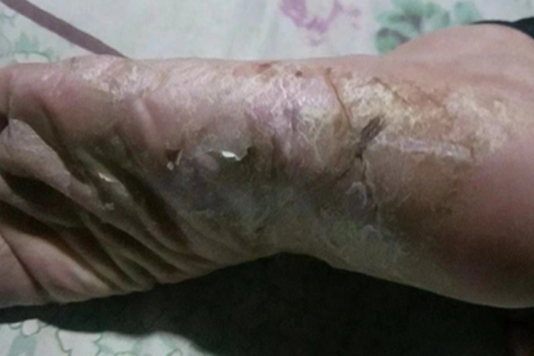 鳞屑角化型足癣皮肤粗糙图