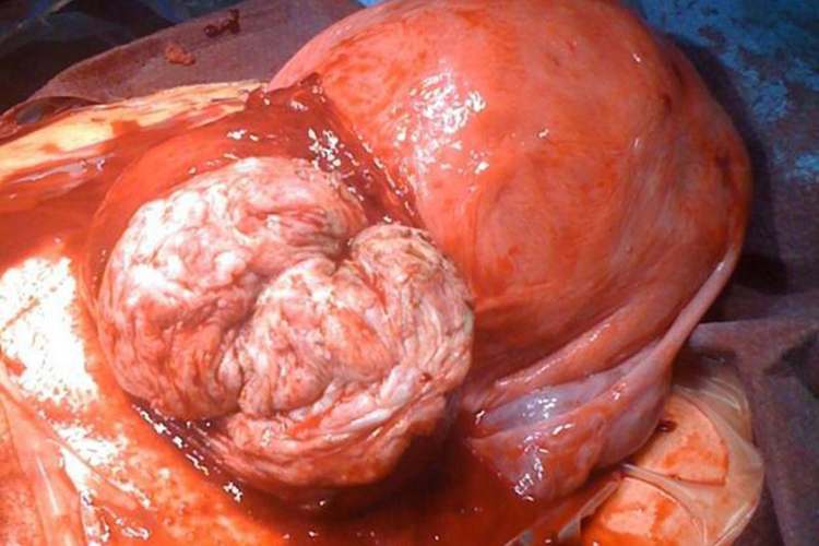 巨大子宫肌瘤图