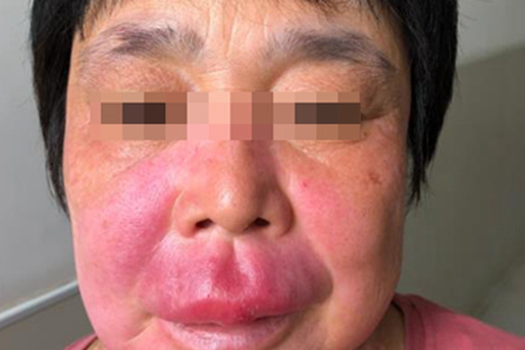 面部肉芽肿面部红肿图