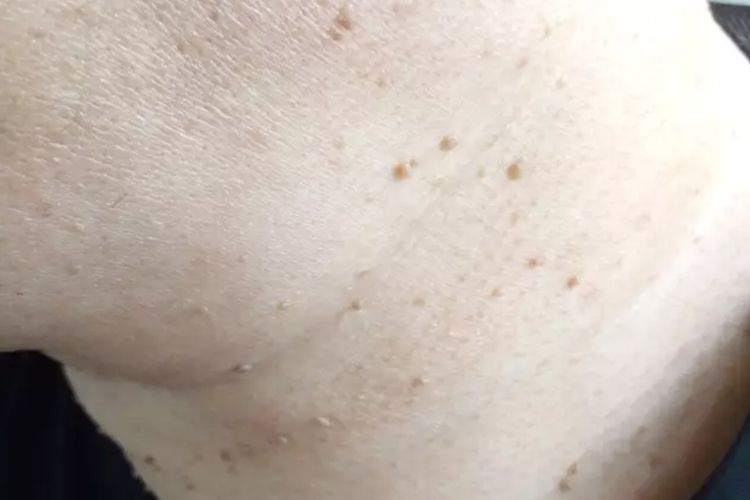 脖子寻常疣图 脖子寻常疣图