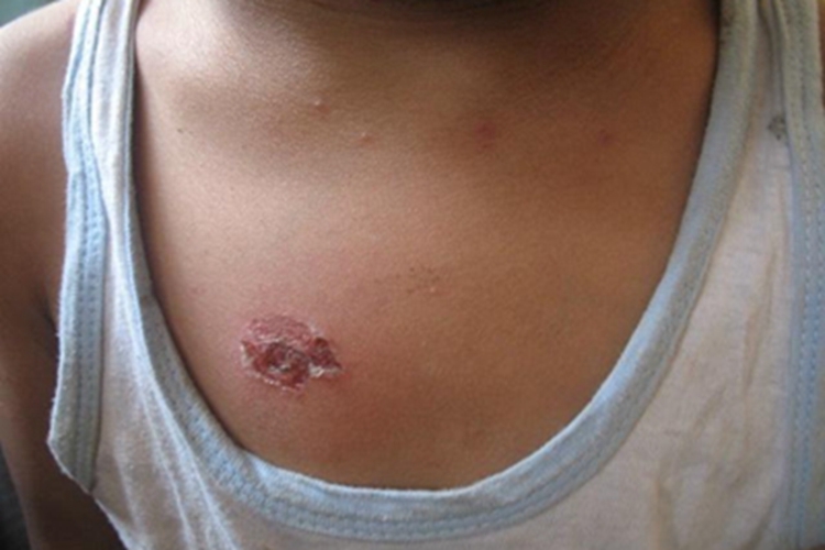 深脓疱疮胸部结痂图