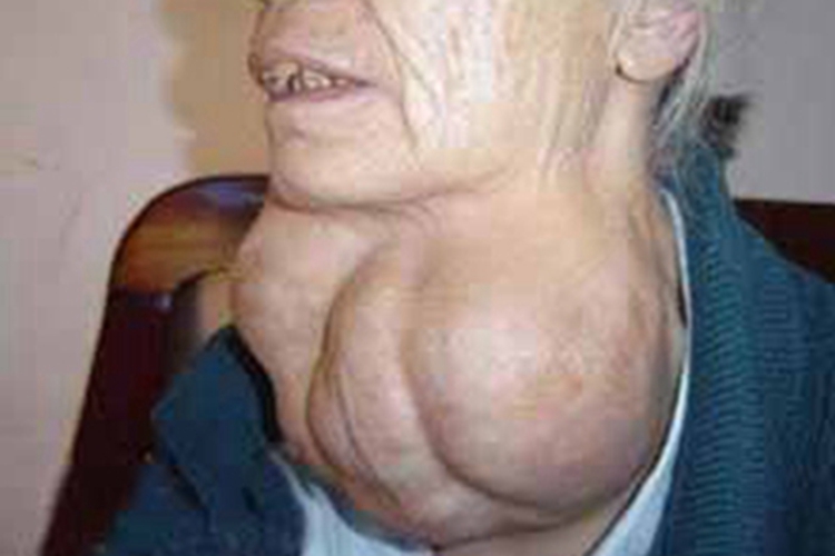 地方性克汀病脖子上长巨大肿块图