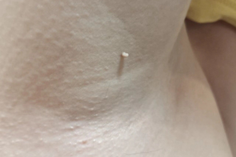 皮肤纤维瘤肉粒图