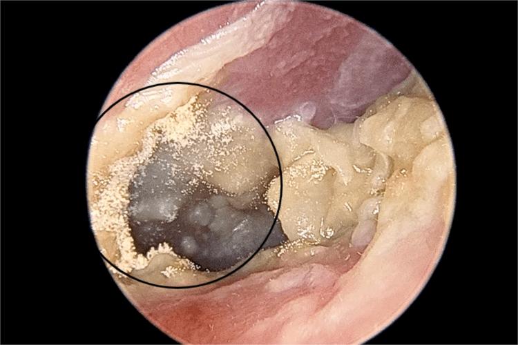 中耳炎长白色霉菌图