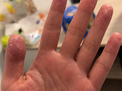 鳞屑角化型手癣手指尖脱皮发红图