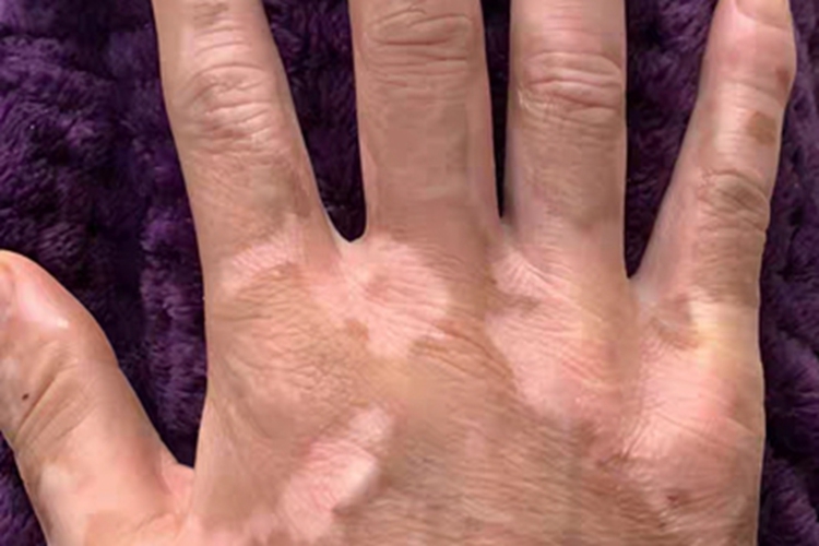 白癜风手背症状图 白癜风手背症状图