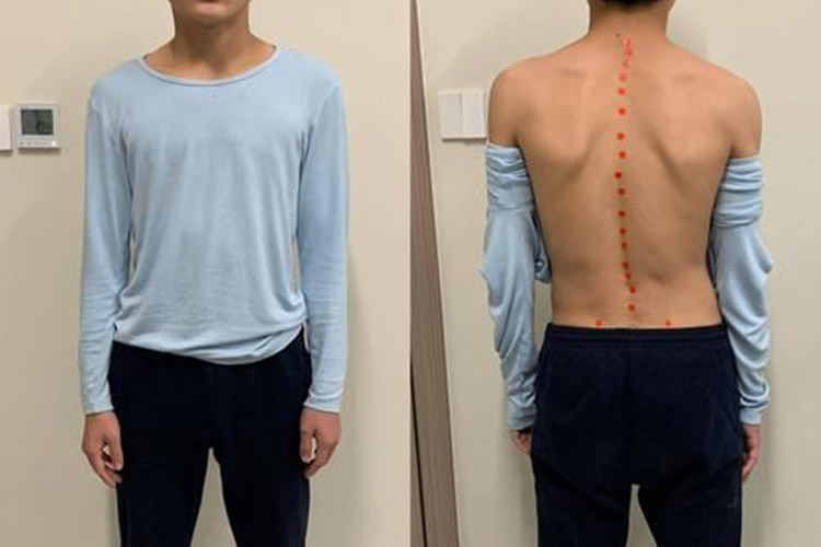 脊柱侧弯C型两肩不等高图