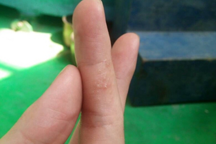 手部湿疹中指上有小水疱图