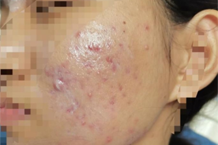 暴发性玫瑰痤疮面部有小疙瘩图 暴发性玫瑰痤疮面部有小疙瘩图