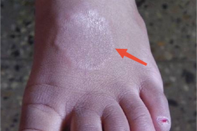 局限型环状肉芽肿脚背长斑图