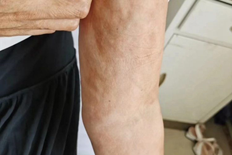 硬皮病胳膊皮肤萎缩图