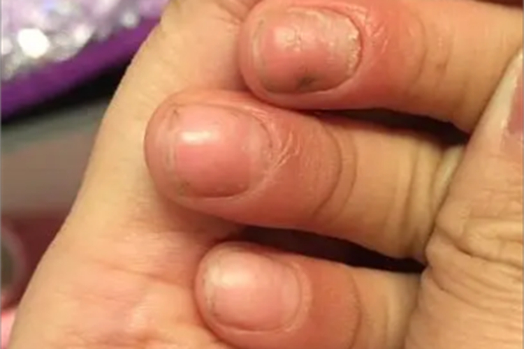 慢性甲沟炎手指甲周围红肿图