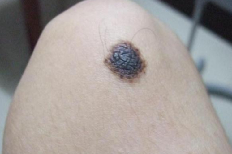 复合痣膝盖症状图