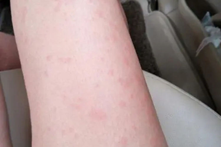 海鲜过敏大腿好几片红斑图