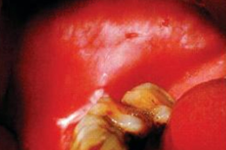口腔白角化症图 口腔白角化症图