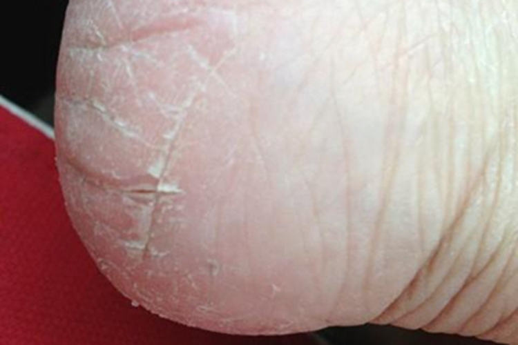 干燥病脚后跟脱皮图