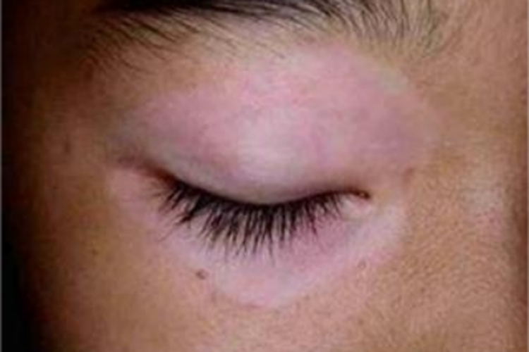 白癜风眼周症状图 白癜风眼周症状图