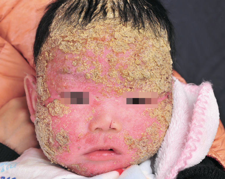 婴儿脂溢性湿疹图 婴儿脂溢性湿疹图