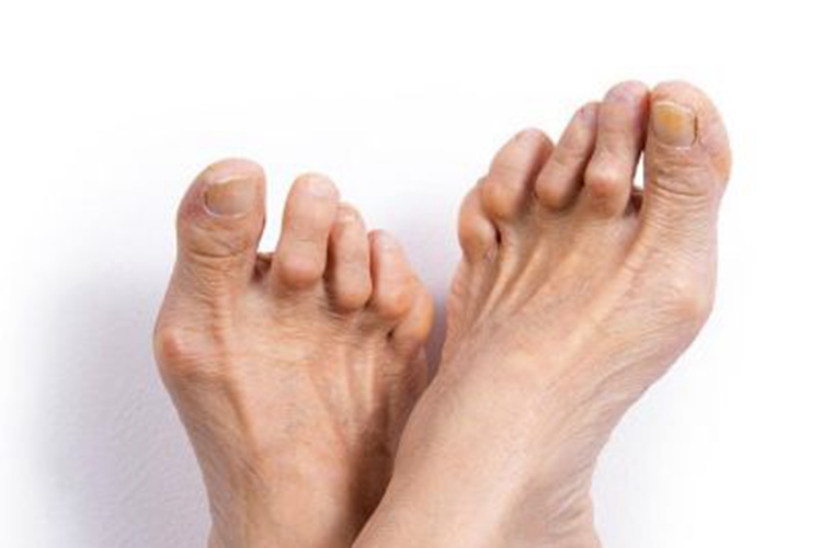 风湿热脚趾关节变形图