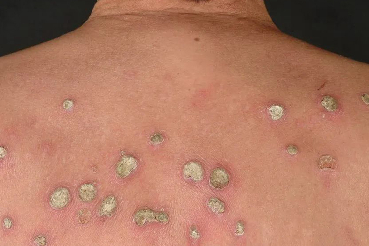 后背角化栓红色斑块图