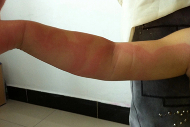 离心性环状红斑胳膊红斑图