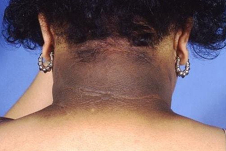 恶性黑棘皮病颈部症状图