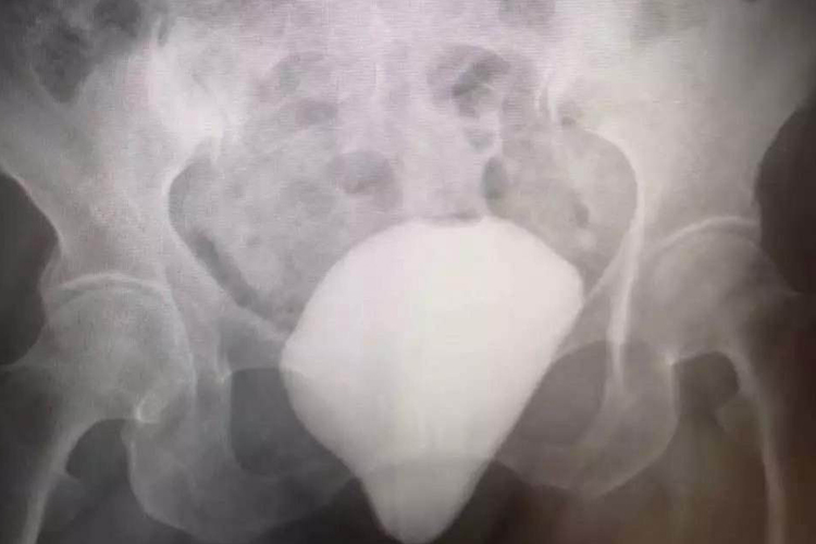 膀胱膨出Ⅱ度图